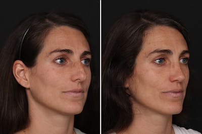 Rhinoplasty Before & After Gallery - Patient 170738 - Image 1