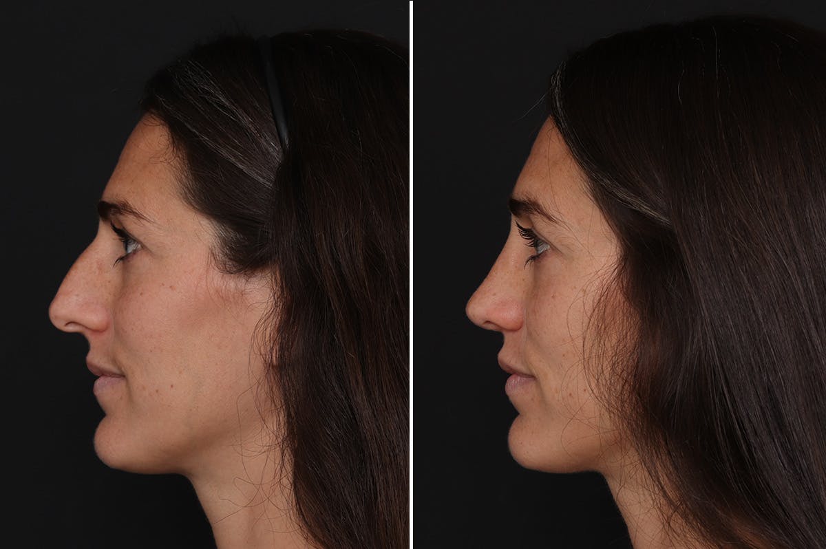 Rhinoplasty Before & After Gallery - Patient 170738 - Image 2