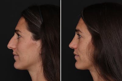 Rhinoplasty Before & After Gallery - Patient 170738 - Image 1