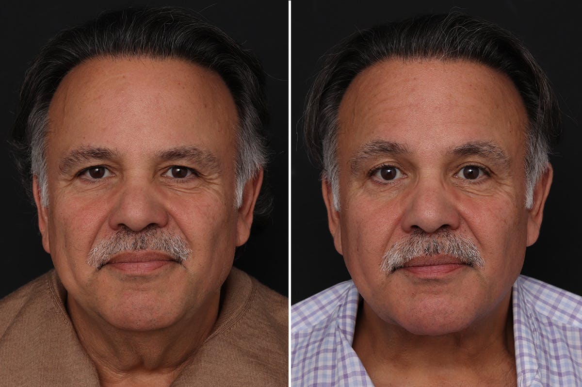 Neck Lift Before & After Gallery - Patient 303442 - Image 3