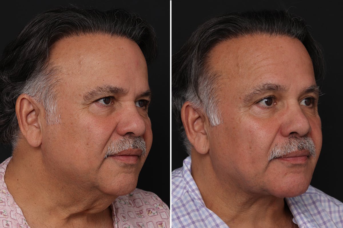Neck Lift Before & After Gallery - Patient 303442 - Image 2