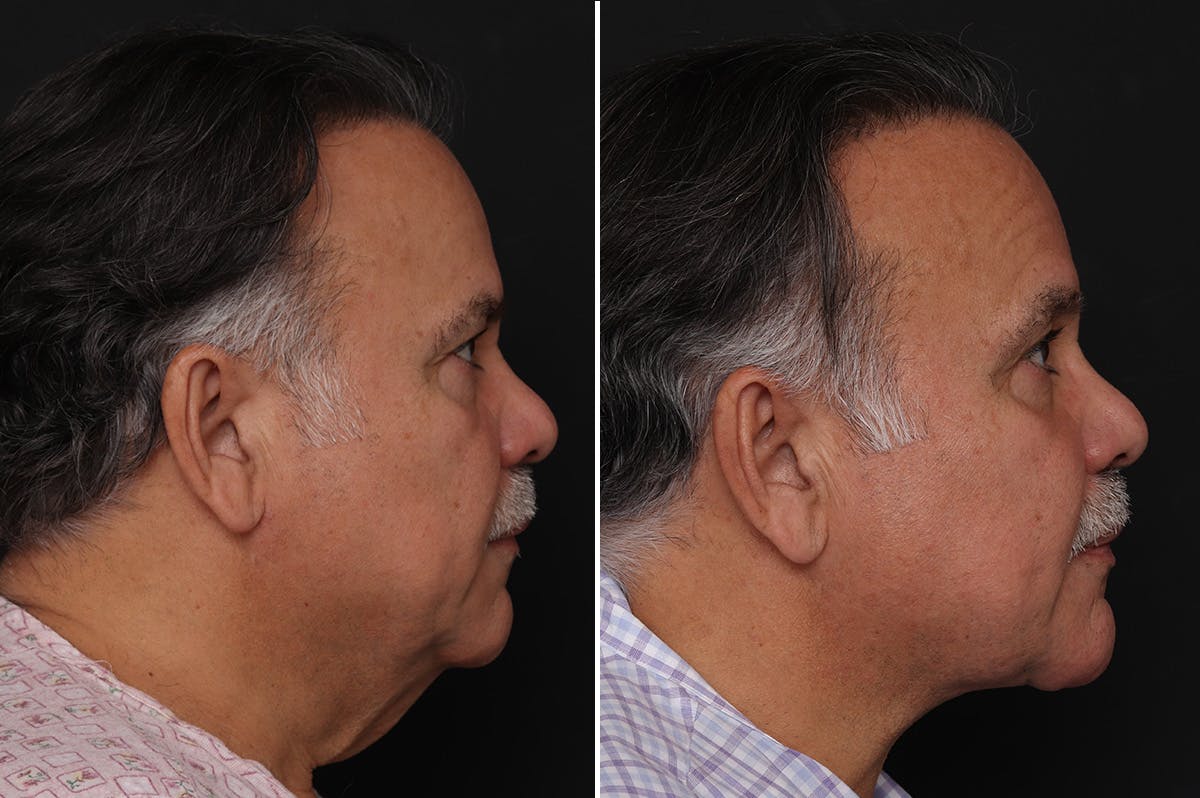 Neck Lift Before & After Gallery - Patient 303442 - Image 4