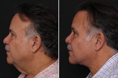 Neck Lift Before & After Gallery - Patient 303442 - Image 1