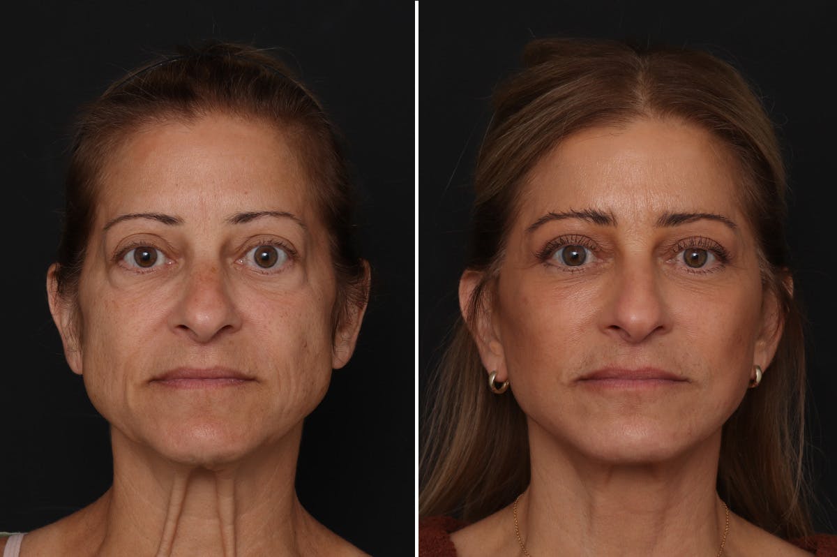 Fat Transfer Before & After Gallery - Patient 236333 - Image 1