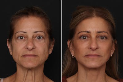 Upper Eyelid Before & After Gallery - Patient 247497 - Image 1