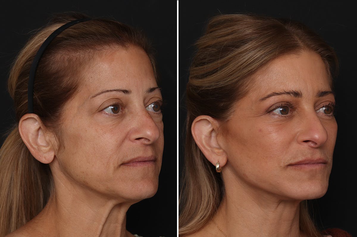 Fat Transfer Before & After Gallery - Patient 236333 - Image 2