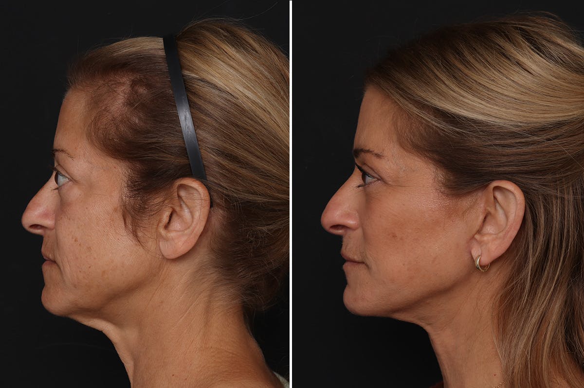Fat Transfer Before & After Gallery - Patient 236333 - Image 3