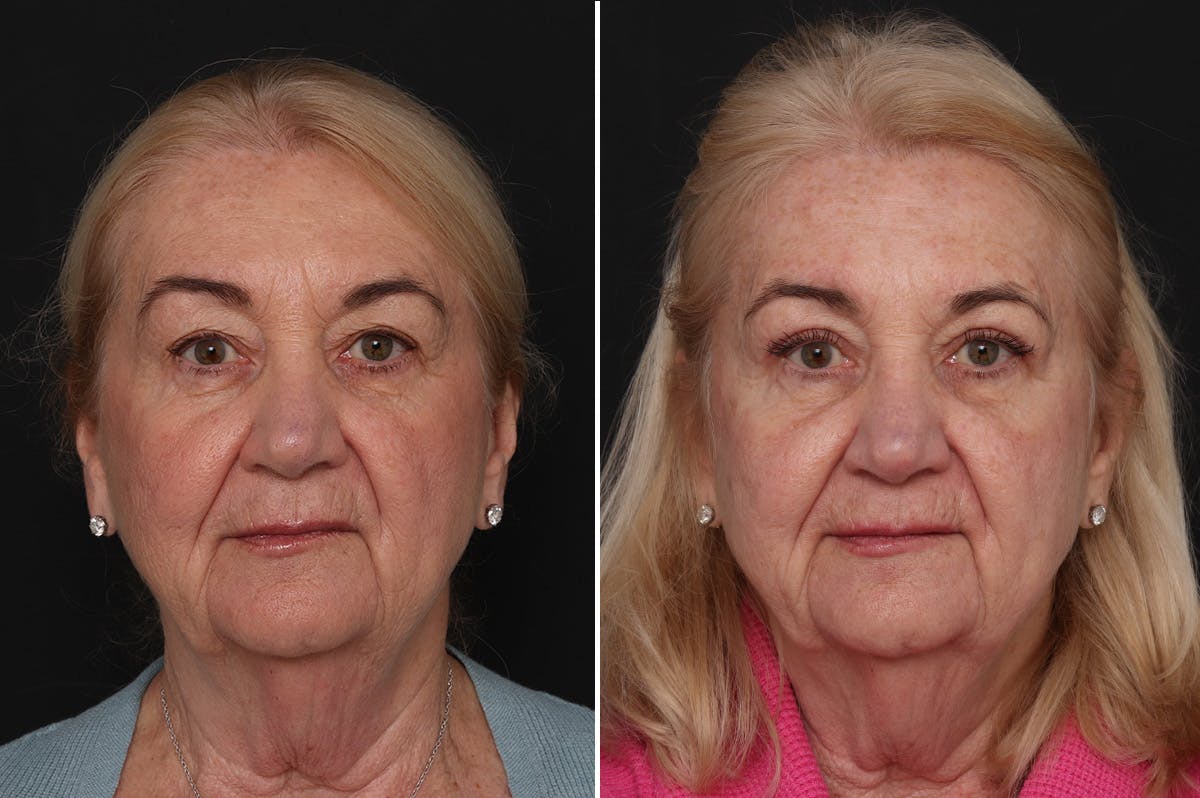 Upper Eyelid Before & After Gallery - Patient 382527 - Image 1