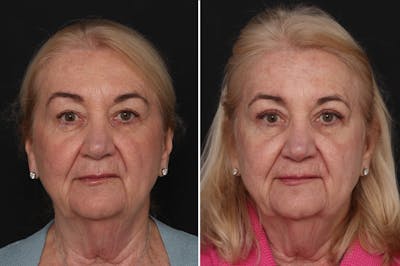 Upper Eyelid Before & After Gallery - Patient 382527 - Image 1