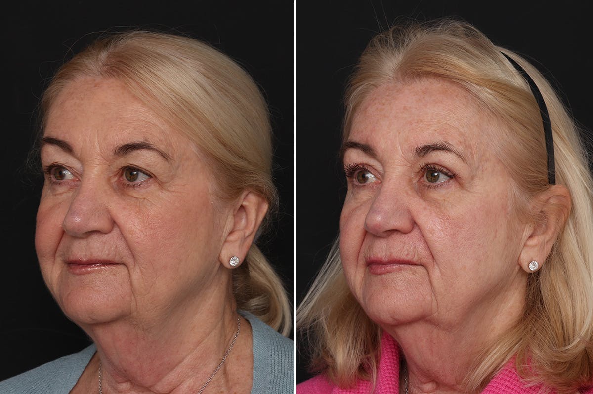 Upper Eyelid Before & After Gallery - Patient 382527 - Image 3