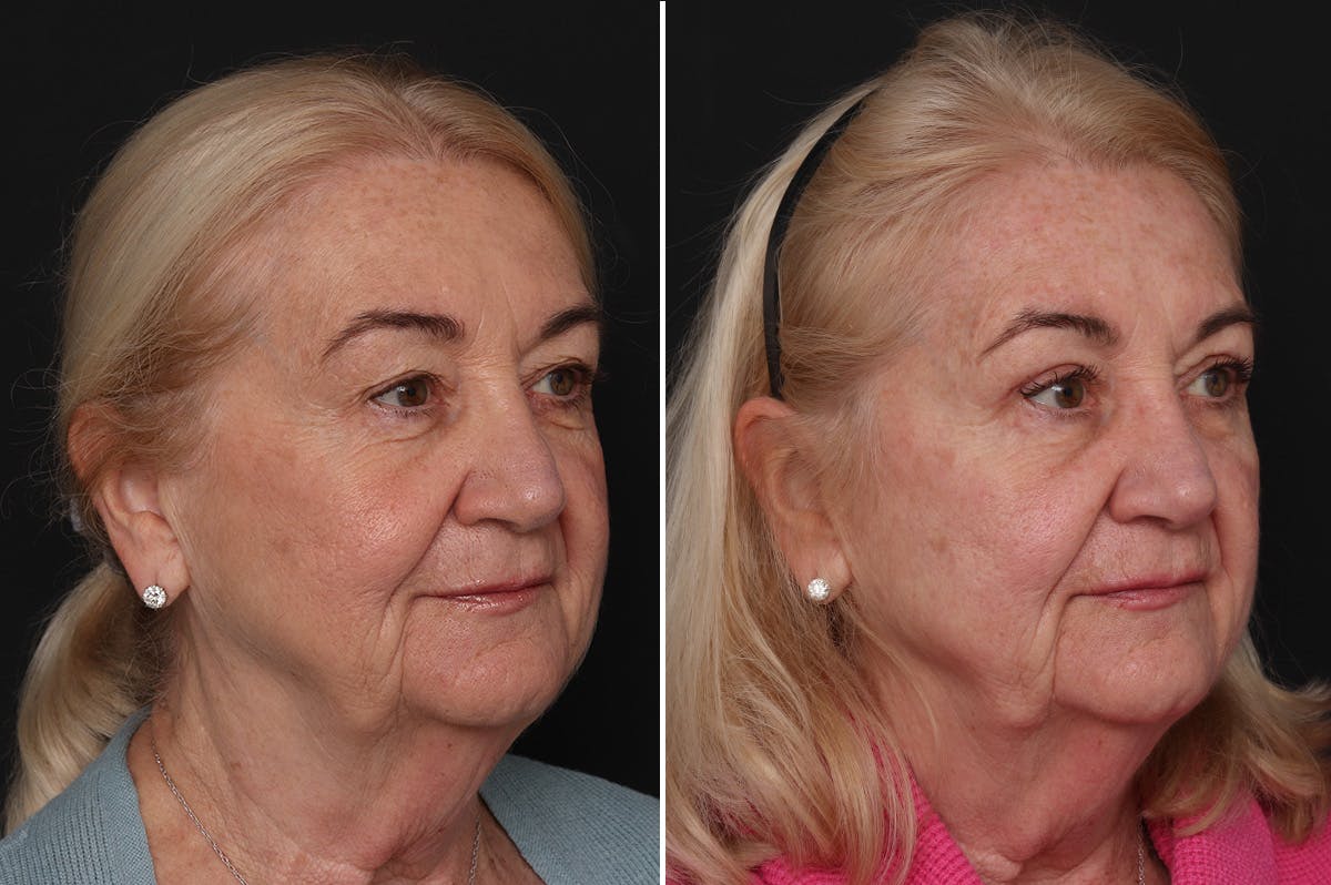 Upper Eyelid Before & After Gallery - Patient 382527 - Image 2