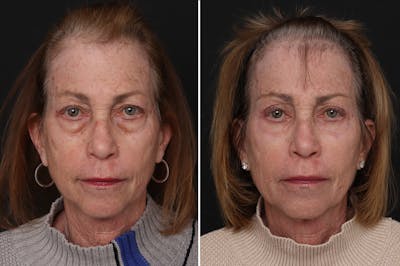 Upper Eyelid Before & After Gallery - Patient 101600 - Image 1