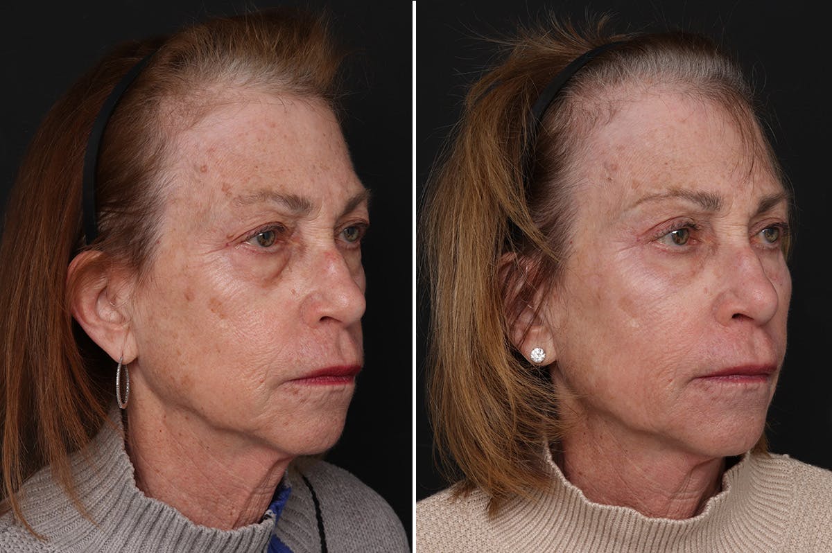 Fat Transfer Before & After Gallery - Patient 169242 - Image 2