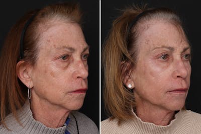 Fat Transfer Before & After Gallery - Patient 169242 - Image 1