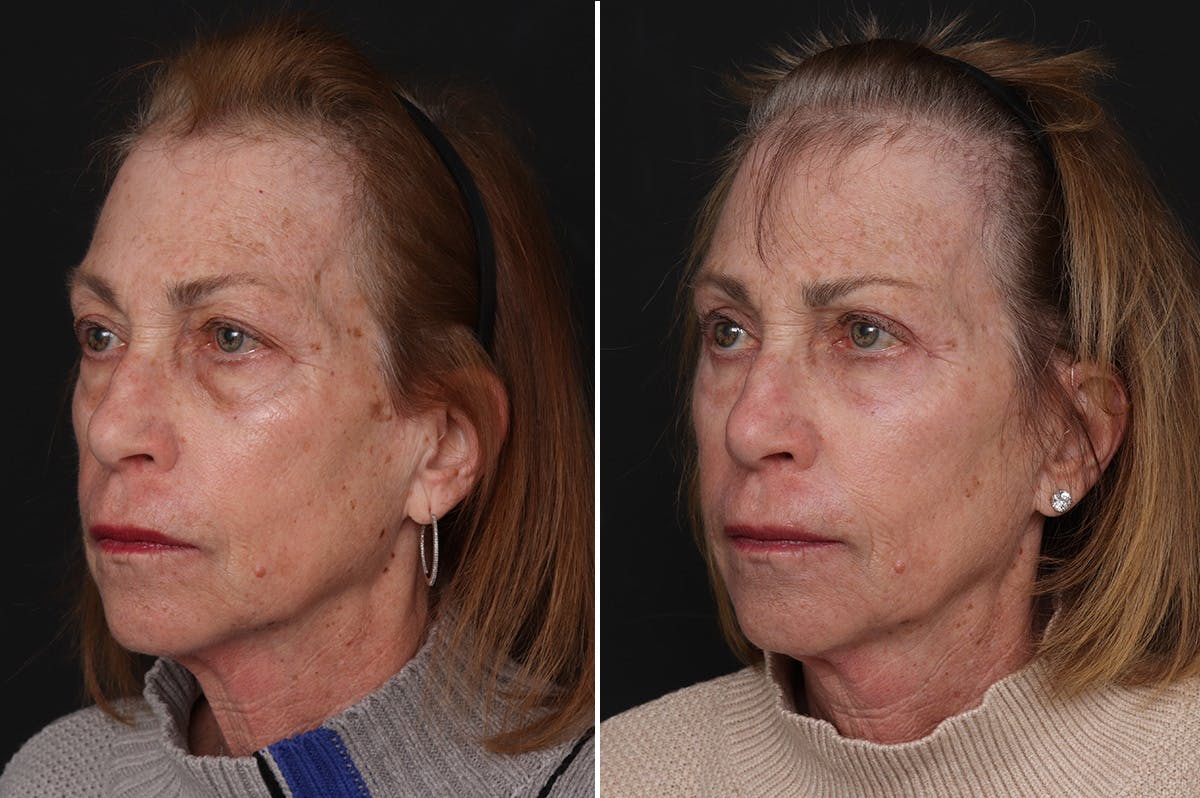 Fat Transfer Before & After Gallery - Patient 169242 - Image 3