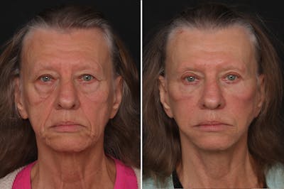 Upper Eyelid Before & After Gallery - Patient 378095 - Image 1