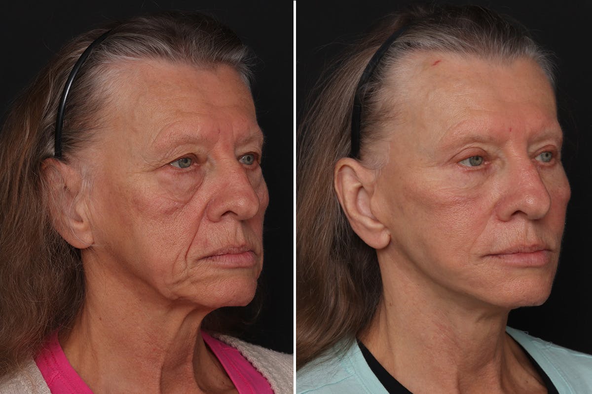 Fat Transfer Before & After Gallery - Patient 342495 - Image 2