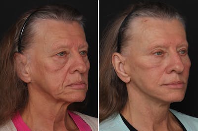 Fat Transfer Before & After Gallery - Patient 342495 - Image 1