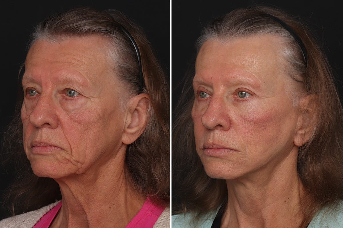 Fat Transfer Before & After Gallery - Patient 342495 - Image 3