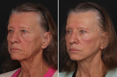 Facelift Before & After Gallery - Patient 409208 - Image 1