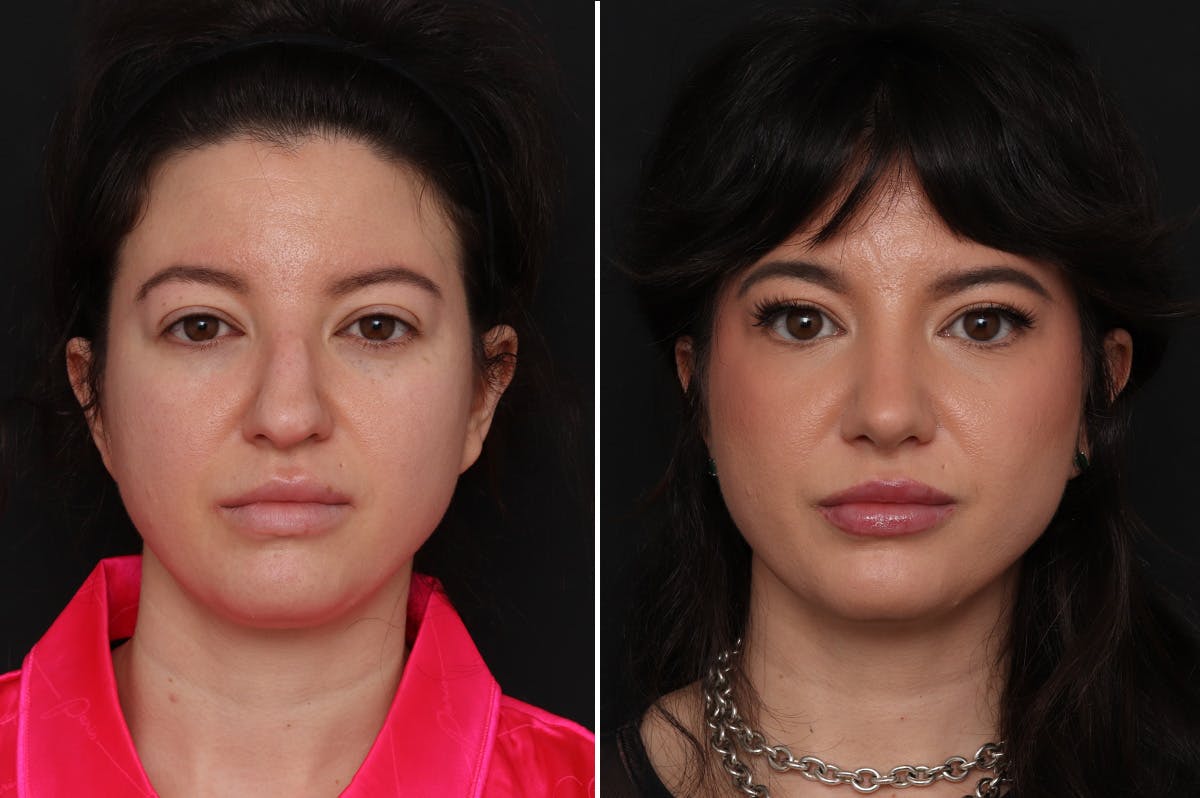 Rhinoplasty Before & After Gallery - Patient 214920 - Image 2