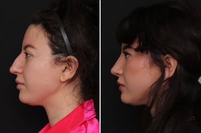 Rhinoplasty Before & After Gallery - Patient 214920 - Image 1
