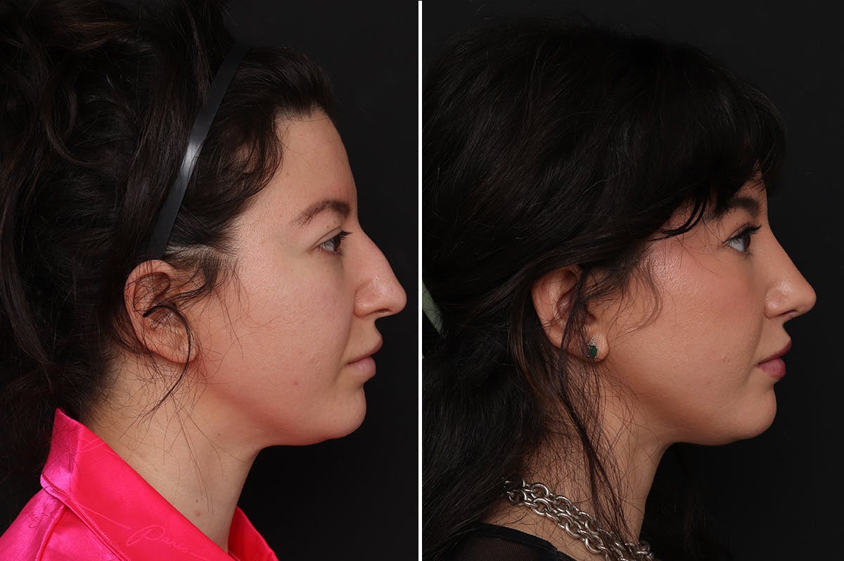 Rhinoplasty Before & After Gallery - Patient 214920 - Image 3