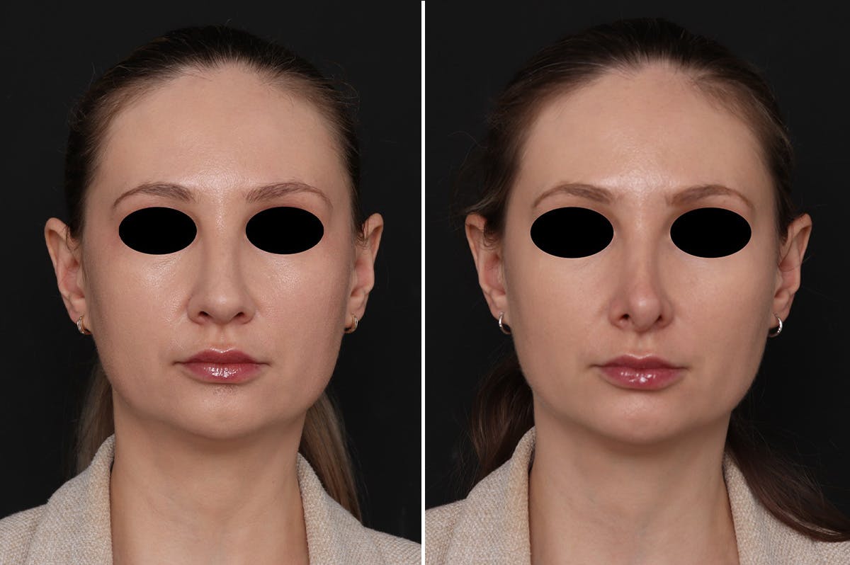 Revision Rhinoplasty Before & After Gallery - Patient 201353 - Image 3