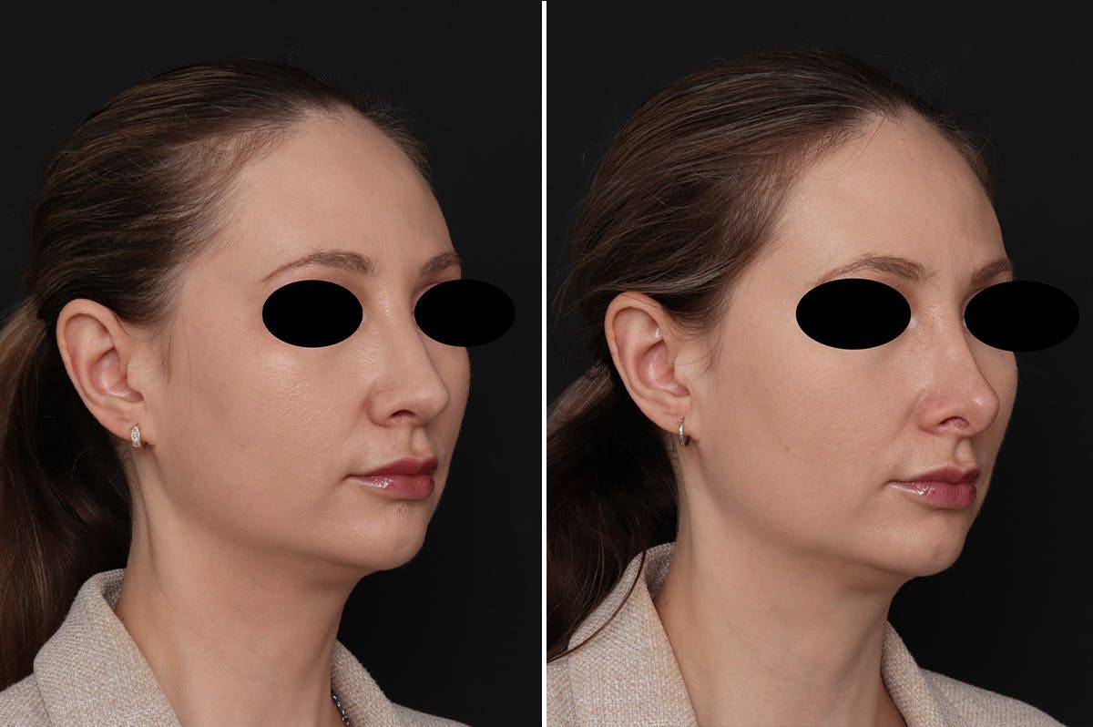 Revision Rhinoplasty Before & After Gallery - Patient 201353 - Image 2