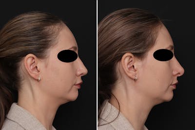 Revision Rhinoplasty Before & After Gallery - Patient 201353 - Image 1