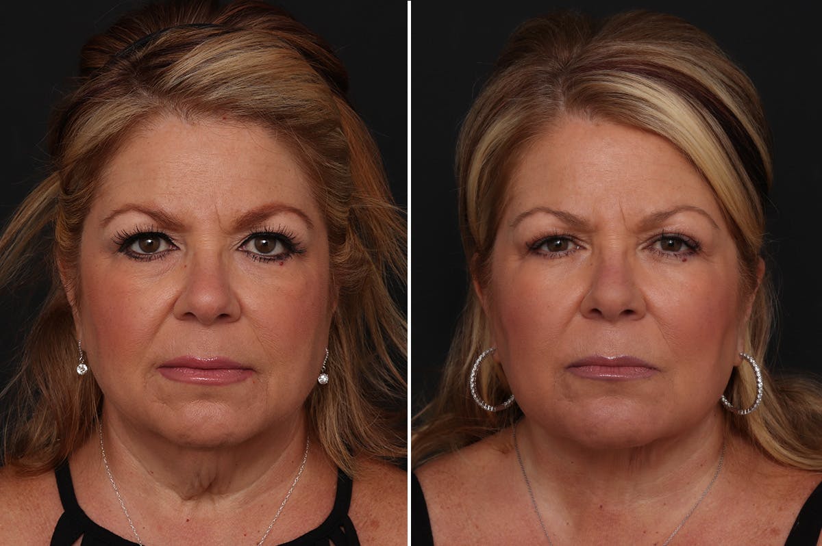 Neck Lift Before & After Gallery - Patient 326010 - Image 3