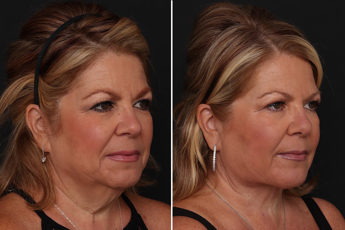 Neck Lift Before & After Gallery - Patient 326010 - Image 2