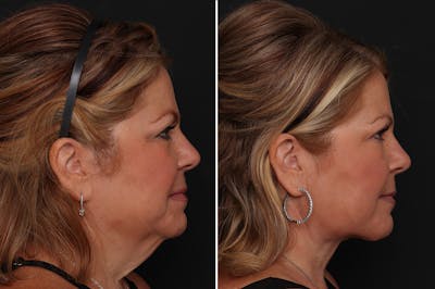 Neck Lift Before & After Gallery - Patient 326010 - Image 1
