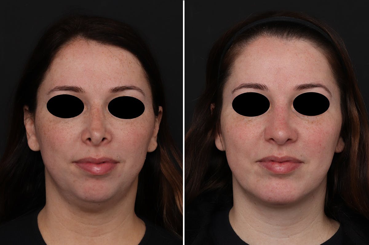 Chin Implants Before & After Gallery - Patient 111630 - Image 3