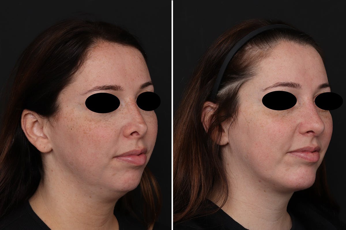 Chin Implants Before & After Gallery - Patient 111630 - Image 4