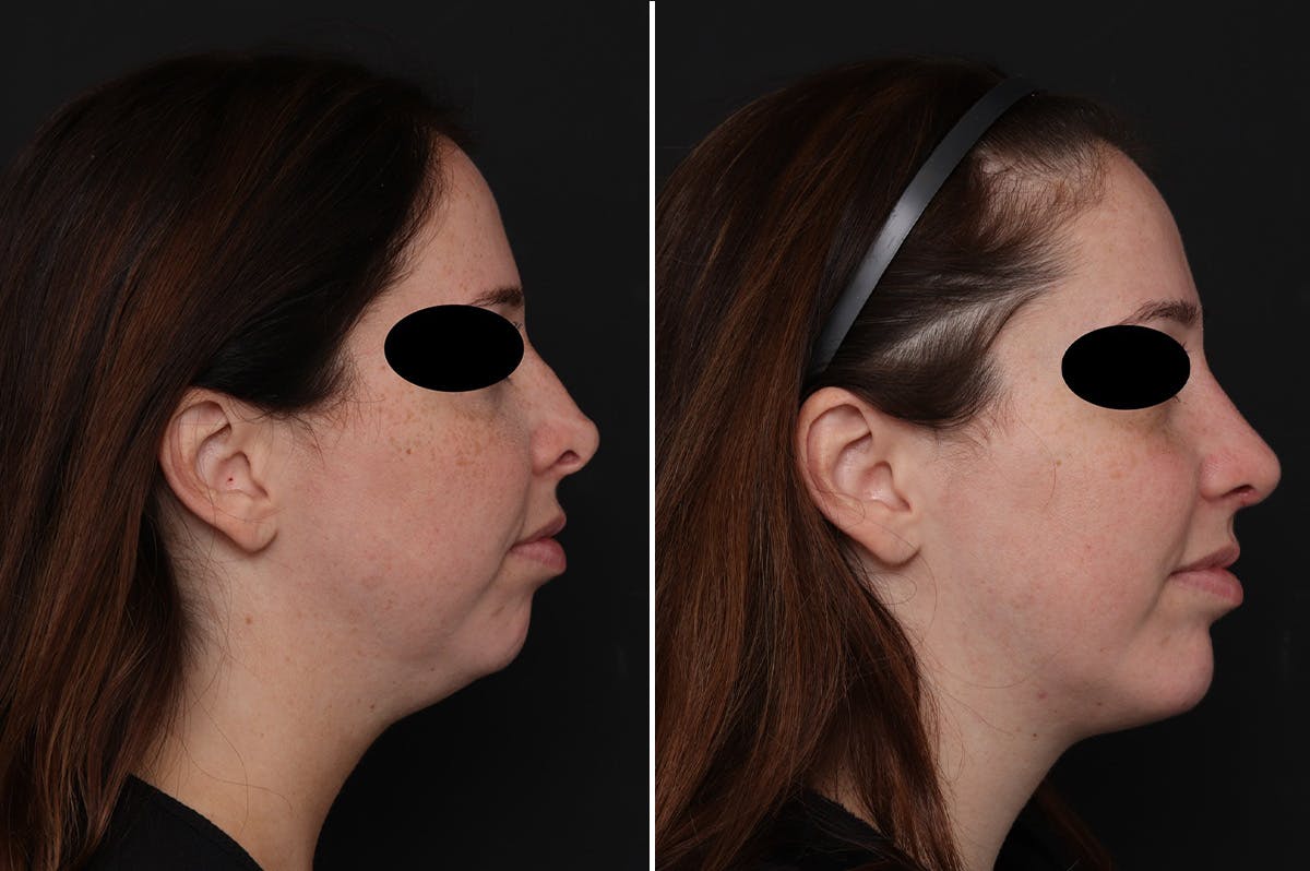 Chin Implants Before & After Gallery - Patient 111630 - Image 5