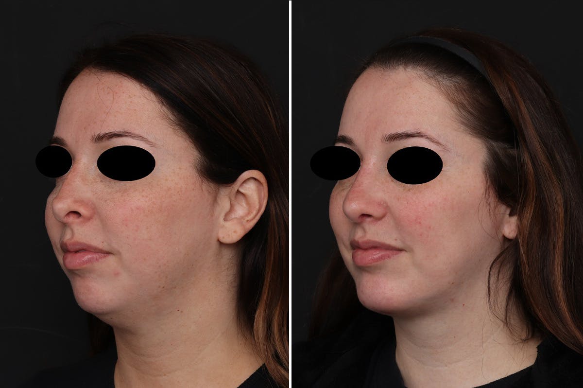Chin Implants Before & After Gallery - Patient 111630 - Image 2