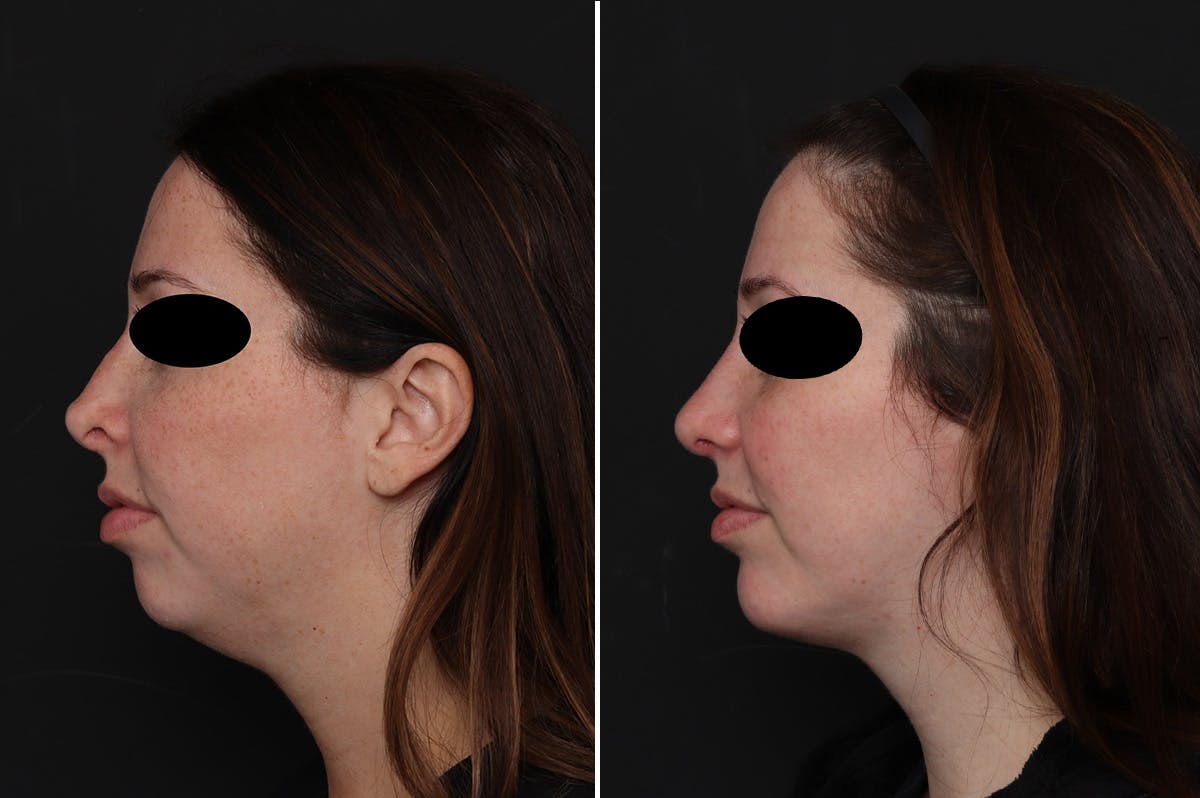 Chin Implants Before & After Gallery - Patient 111630 - Image 1
