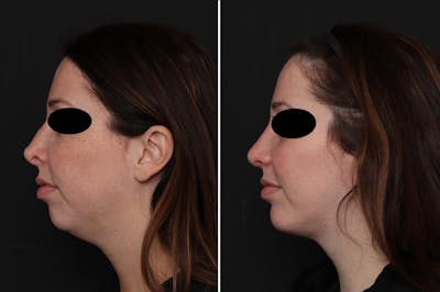 Revision Rhinoplasty Before & After Gallery - Patient 108298 - Image 1