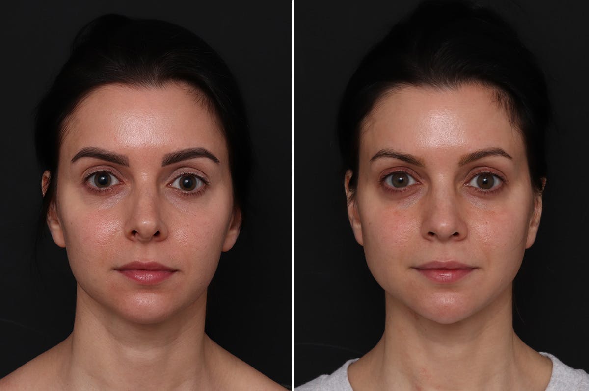 Revision Rhinoplasty Before & After Gallery - Patient 596596 - Image 2