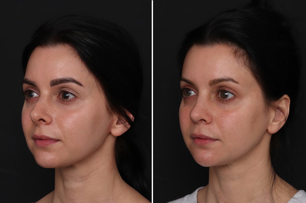 Revision Rhinoplasty Before & After Gallery - Patient 596596 - Image 4