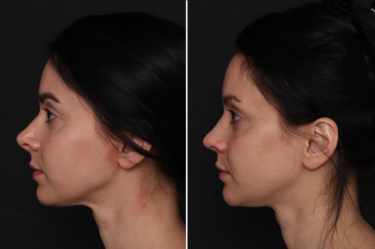 Revision Rhinoplasty Before & After Gallery - Patient 596596 - Image 1