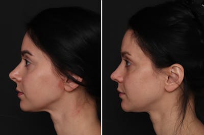 Revision Rhinoplasty Before & After Gallery - Patient 596596 - Image 1