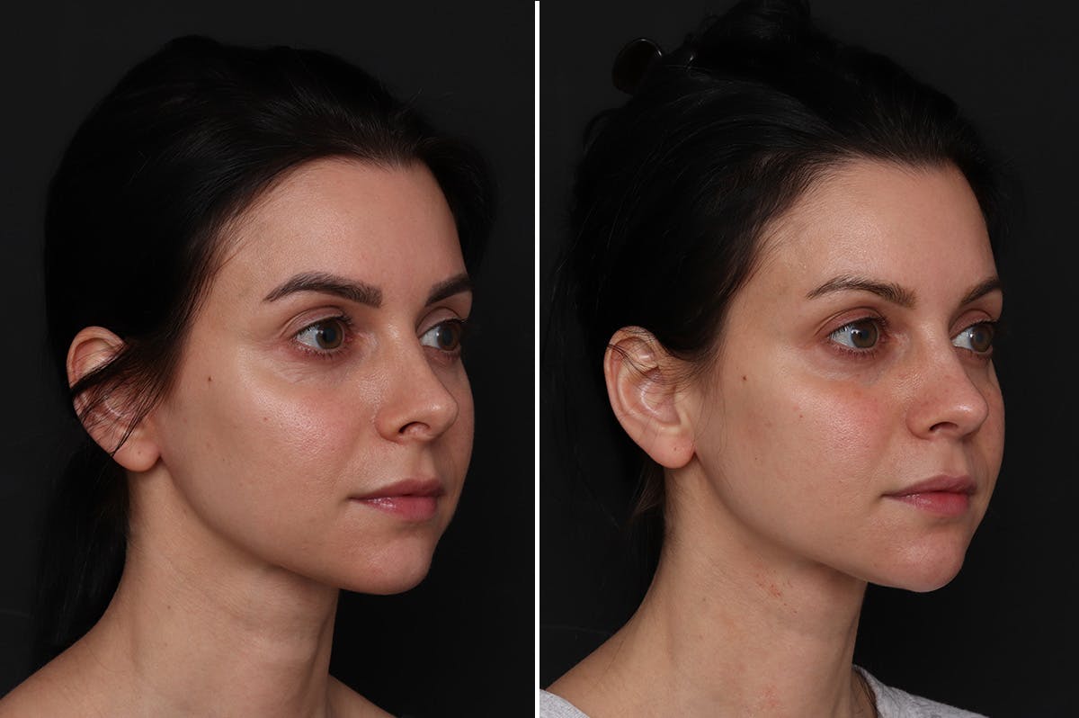 Revision Rhinoplasty Before & After Gallery - Patient 596596 - Image 3