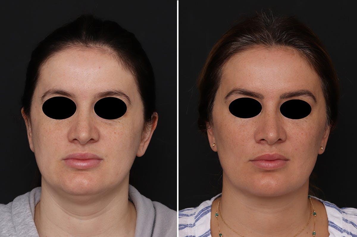 Fat Transfer Before & After Gallery - Patient 233675 - Image 1