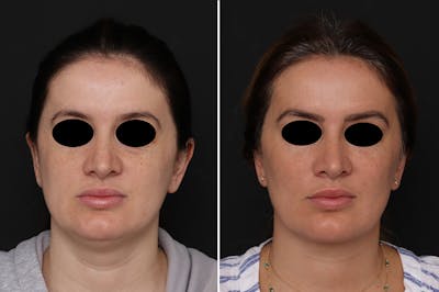 Fat Transfer Before & After Gallery - Patient 233675 - Image 1