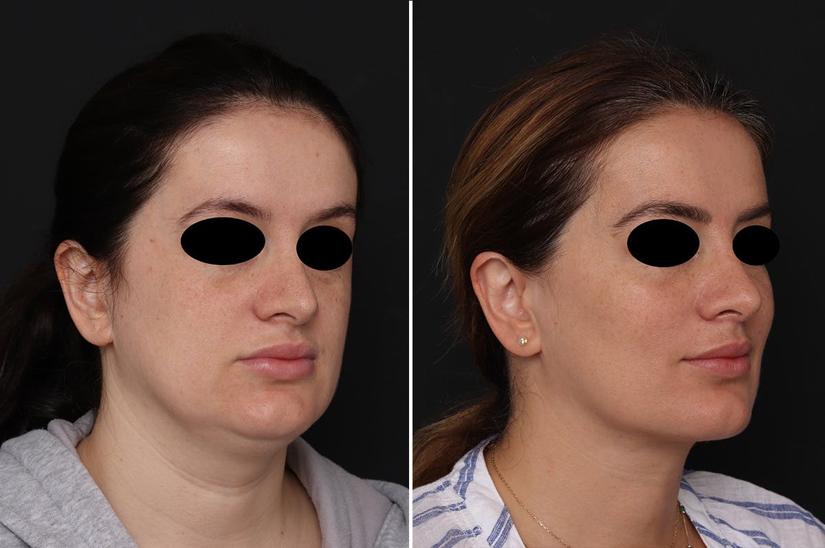 Fat Transfer Before & After Gallery - Patient 233675 - Image 2