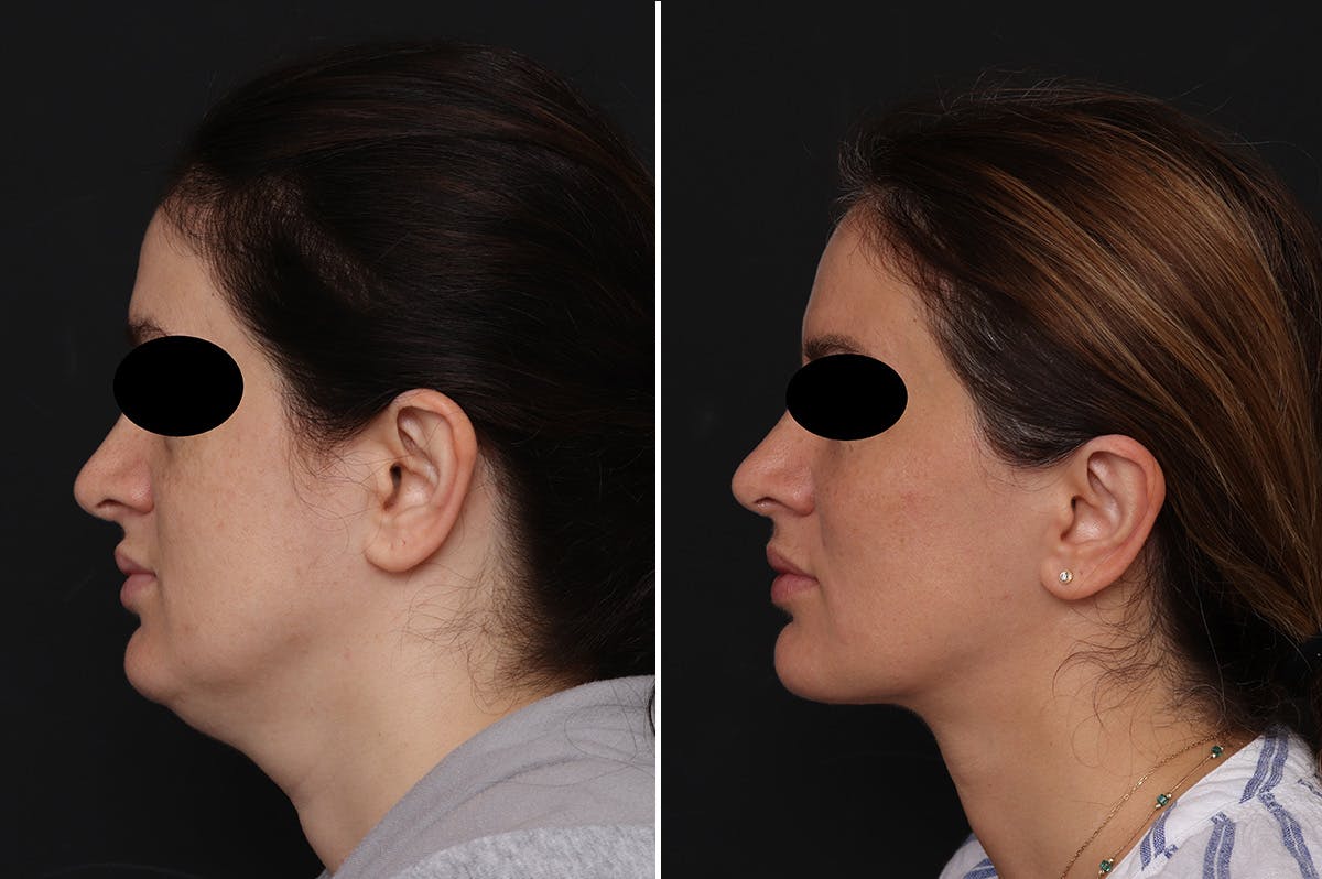 Fat Transfer Before & After Gallery - Patient 233675 - Image 3