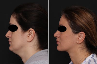 Neck Lift Before & After Gallery - Patient 812942 - Image 1