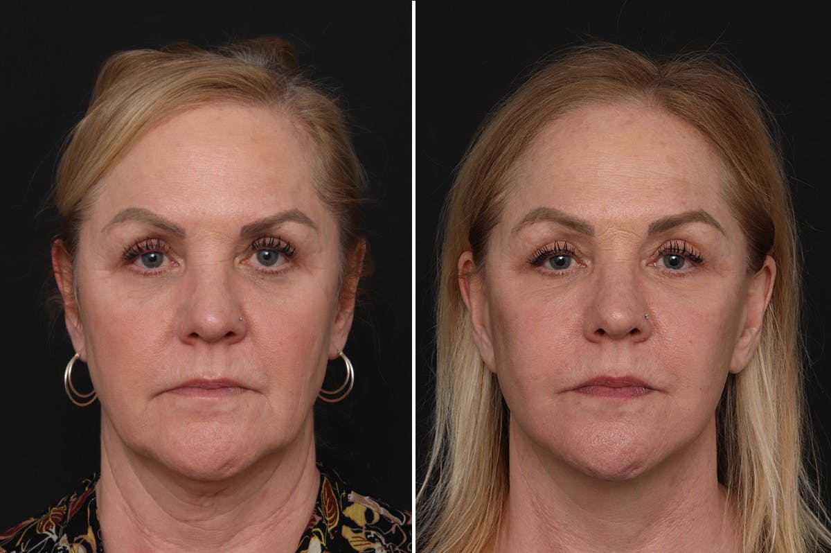Facelift Before & After Gallery - Patient 651168 - Image 2